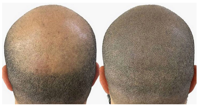 What is micropigmentation?